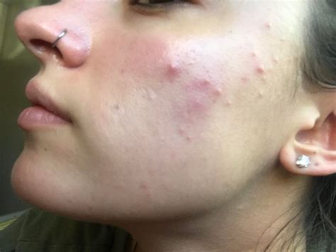 Acne Are These Blind Pimples Very Painful And Dont Come To A Head