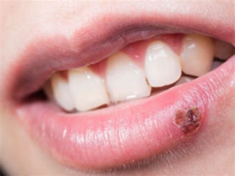 Cold Sores Symptoms Causes Treatment And More