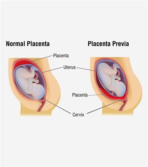 Placenta Previa What It Is Types Causes And Treatment