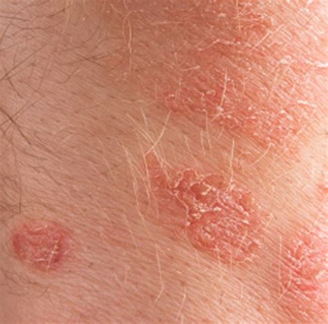 Patches Of Dry Skin Pictures Photos