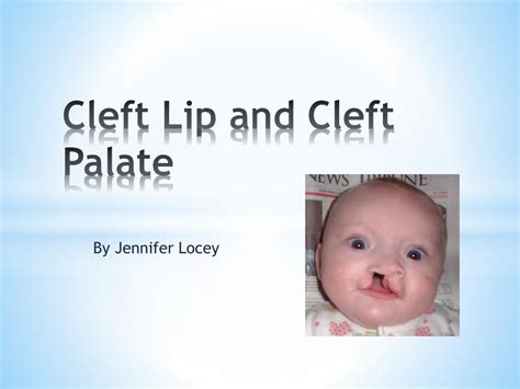 Pathophysiology Of Cleft Lip And Palate Ppt