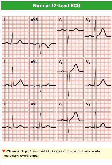 Normal 12 Lead Ecg Complexes Icu Nursing Cardiology Nursing Normal Ecg