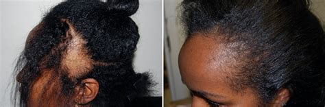 Check spelling or type a new query. Hair Loss Associated with Age Becoming More Common ...