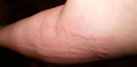 Hives Rash 10 Serious Conditions That Rashes And Hives Can Indicate Things Health