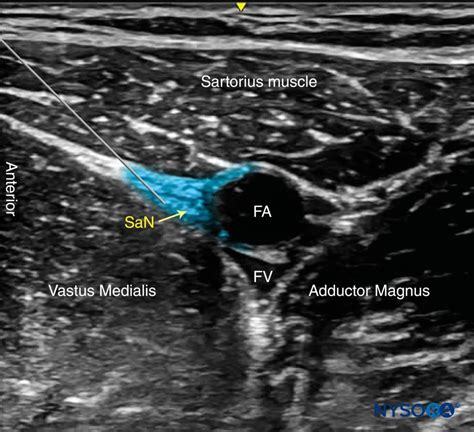 Ultrasound Guided Saphenous Adductor Canal Block Nysora