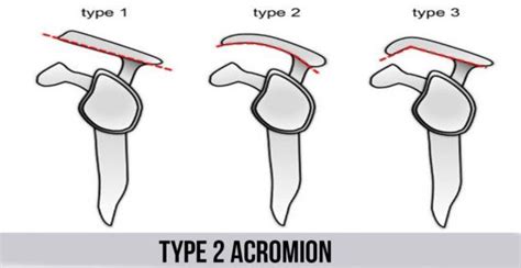 Type 2 Acromion Shoulder Anatomy Type Human Body