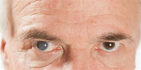 Cataracte Définition Causes Symptômes Opération Traitements