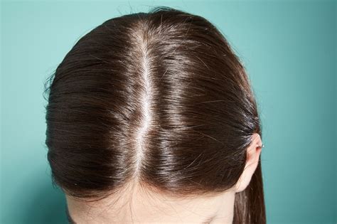 Dandruff And Dry Scalp Issues A Dermatologist Tells All