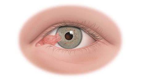 A Visual Guide To Eye Cancer Vinmec