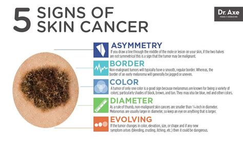 Skin Cancer Photos Early Stages