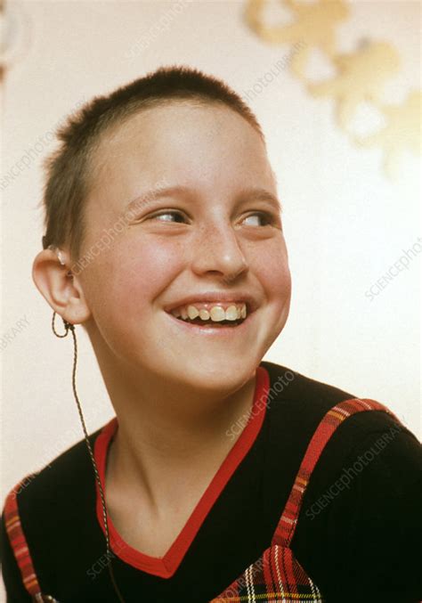 Young Deaf Girl Wearing A Cochlear Implant Device Stock Image M600