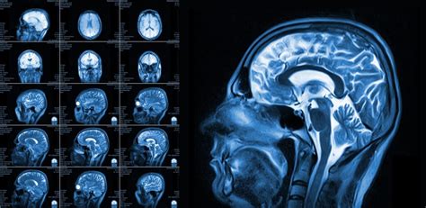 Brain Mri Imaging In Dallas Tx Southwest Diagnostic Imaging Center