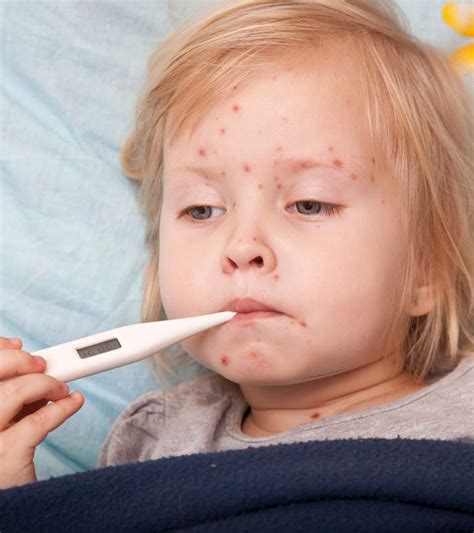 Chickenpox In Kids Causes Treatment And Prevention