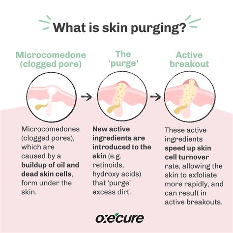 Skin Purging Vs Breaking Out Know The Difference