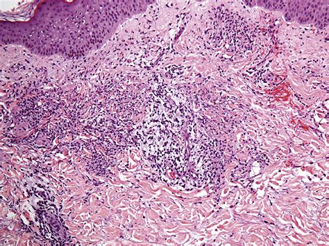 Palisaded Neutrophilic And Granulomatous Dermatitis A Presenting Sign