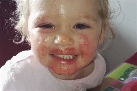 Toddlers Face Eaten Alive By Herpes Virus Caught From Kissing
