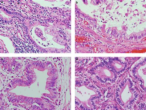 Transition Of Normal Bronchial Epithelial Cells To Mucous Columnar