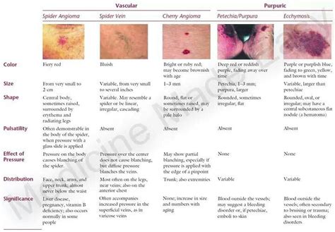 Ecchymosis Cherry Angioma Vs Petechiae The Rash That Becomes Purpuric