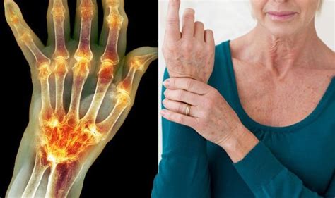 Arthritis Pain Symptoms And Signs Of The Joint Pain Condition Include