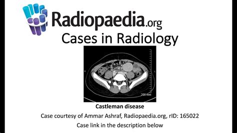 Castleman Disease Cases In Radiology Youtube