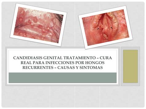 Ppt Candidiasis Genital Tratamiento Cura Real Para Infecciones Por Sexiz Pix