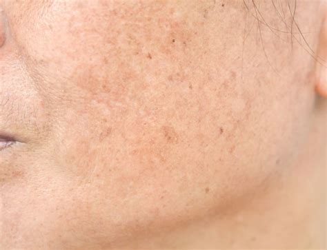 Sun Exposure In 2020 Skin Spots White Skin Spots Skin Treatments