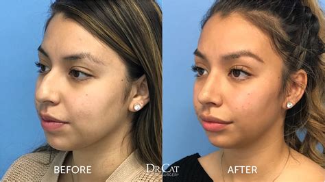 Rhinoplasty Cost And Week By Week Recovery Timeline
