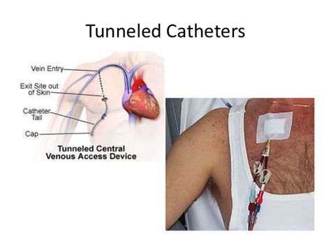 중심정맥관central Venous Catheter Picc에 대해서 종류 합병증 관리 삽입 네이버 블로그