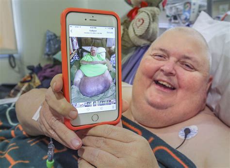 The conversion factor from pounds to kilograms is 0.45359237, which means that 1 pound is equal to nowadays, the most common is the international avoirdupois pound which is legally defined as. Misdiagnosis: 'Fat' Man Actually Plagued With 130-Pound ...