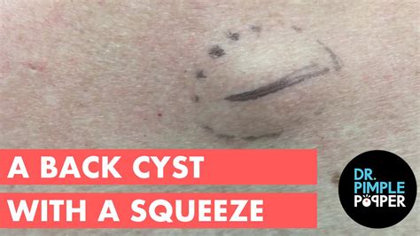 A Back Cyst With A Squeeze Cystactular Cysts Dr Pimple Popper