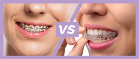 Braces Vs Invisalign Archer Dental