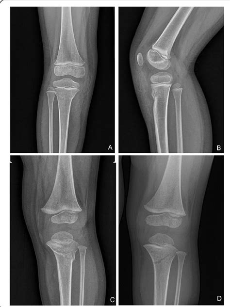 Fracture Pattern Cortical Buckling A Anterior Scooping Of The Notch