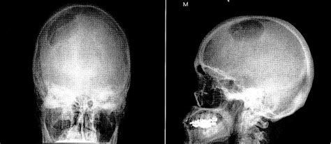 Large Osteolytic Skull Tumor Presenting As A Small Subcutaneous Scalp