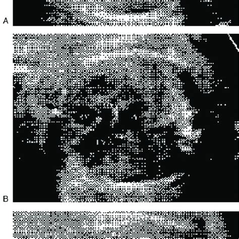 Ebstein S Anomaly A The Four Chamber View Of Fetal Echocardiography