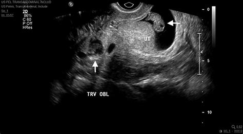 Ruptured Ectopic Pregnancy Ultrasound