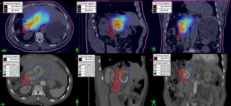 Spectct Image‐based Dosimetry For Yttrium‐90 Radionuclide Therapy