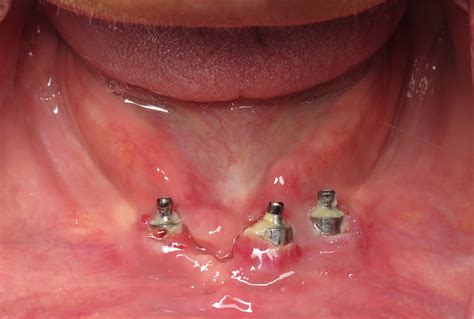 Complications Bone Graft For Failed Full Lower Dental Implants Ramsey