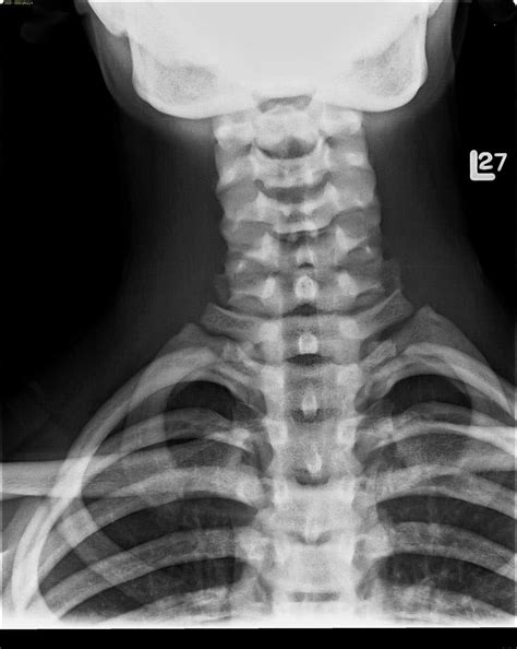 Osteopetrosis X Rays Case Studies Ctisus Ct Scanning