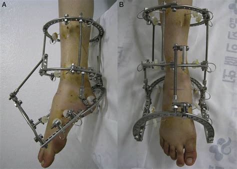 Use Of Ilizarov External Fixation Without Soft Tissue Release To