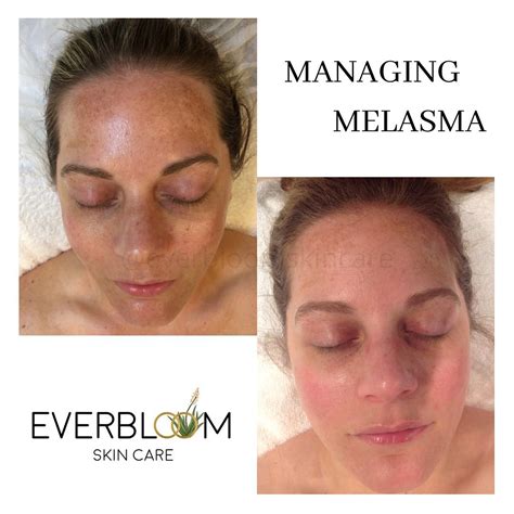 Lets Talk About Managing Melasma Everbloom Skin Care