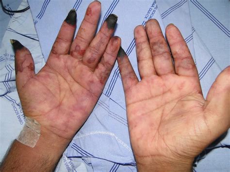 Formigamento nas mãos pode ser inofensivo ou um sinal de doenças graves