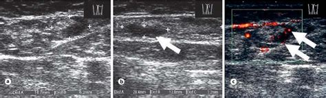 Figure 1 From High Resolution Ultrasound Combined With Power Doppler