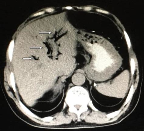The Image Of The Pneumobilia On The Ct Of The Patient Download