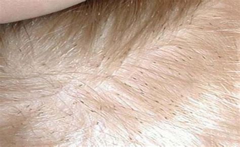 Repeat this method once a week for about two months. Pin on Head Lice Prevention