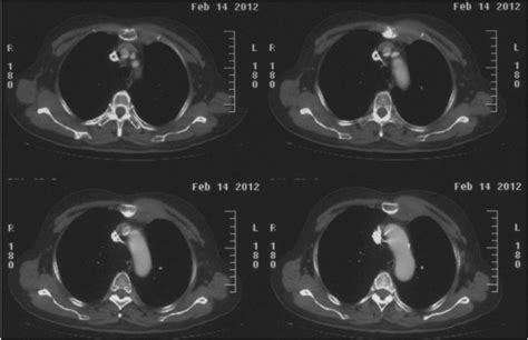 Primary Diffuse Large B Cell Lymphoma Of The Chest Wall A Case Report