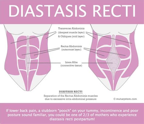 Learn what the condition really is, what causes diastasis recti (dr), how to best prevent it from occurring to you, and how to repair your abdominals if it. How to Prevent and Heal Diastasis Recti | Prenatal workout ...