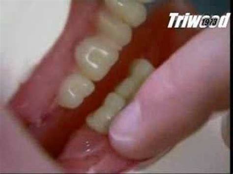 How much do dentures cost? Making Dentures - YouTube