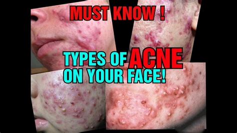 Types Of Acne On Face Youtube