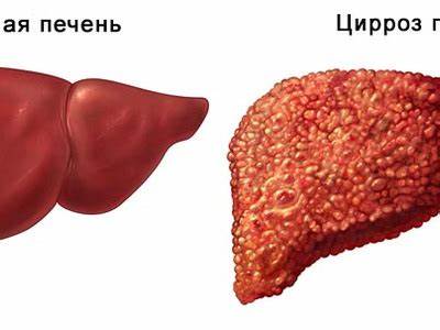 Печень заболевание симптомы диета