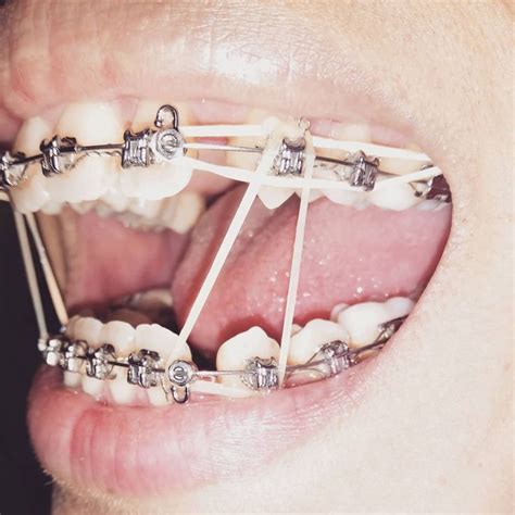 braces girlswithbraces metalbraces elastics hooks braces braces rubber bands braces colors